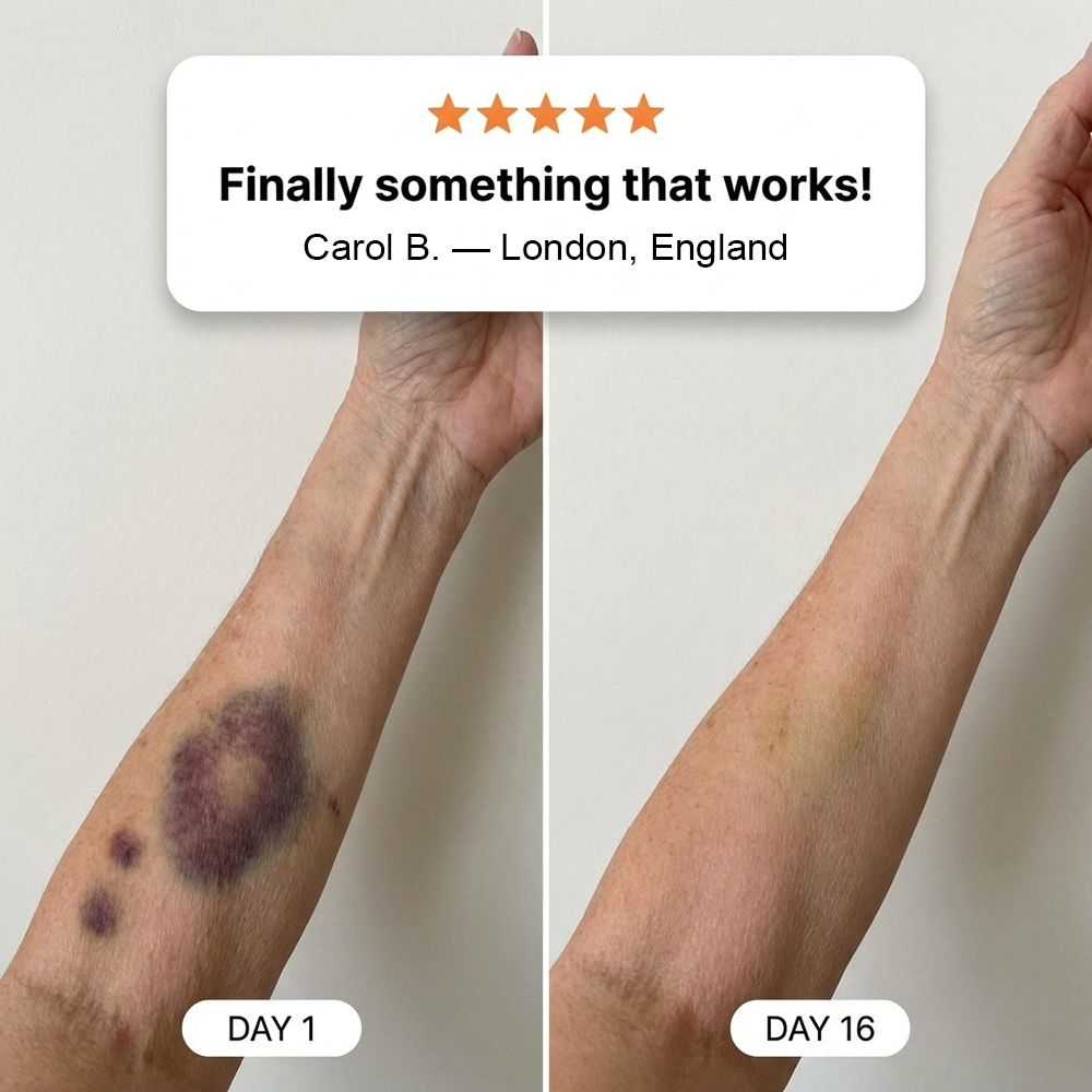 💥Over 100,000 units sold💕 - PURELORA® cream to repair bruises and strengthen the skin